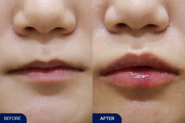 내측인중pkg(잼버실+러시안립필러)