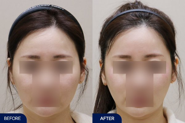 울쎄라 + 디디컷