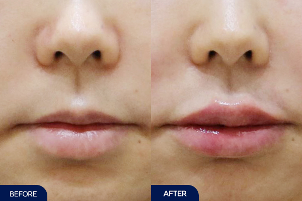 러시안립필러+필러 녹이기